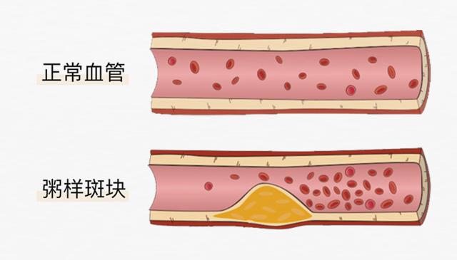 血栓是心梗、腦梗的元兇，很容易找上這些人