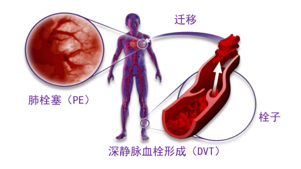 骨科術后重點關注的問題—VTE，該如何防治？