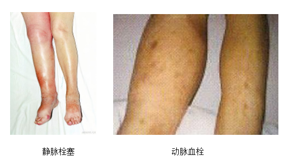 動脈血栓和靜脈血栓有什么區(qū)別嗎？