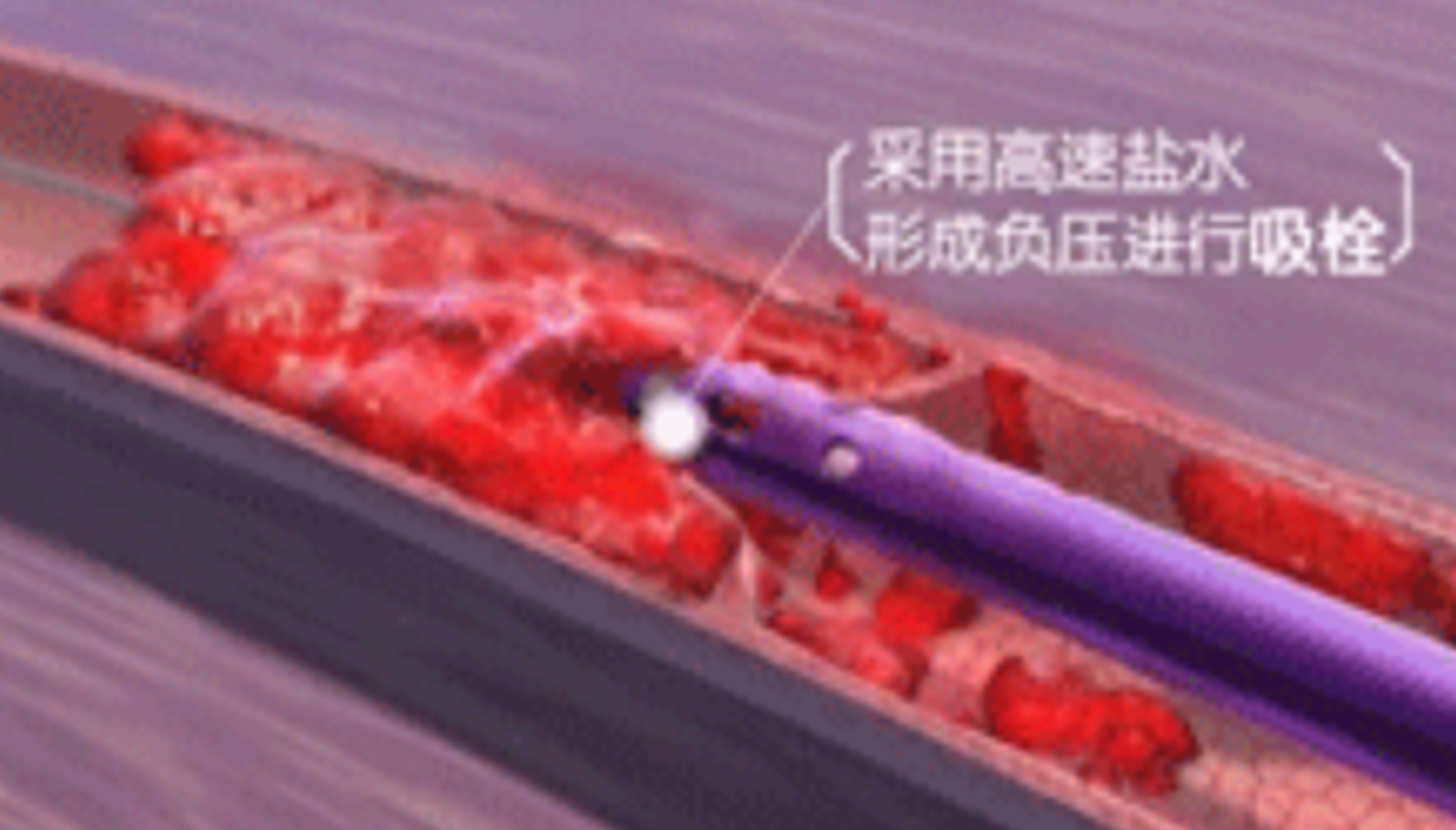 深靜脈血栓能致命，防治“大法”要了解！