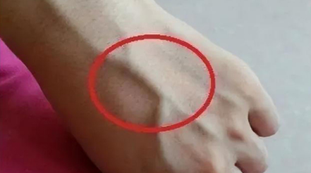 有人手臂上“青筋暴起”，有人卻看不到“青筋”，這是咋回事？