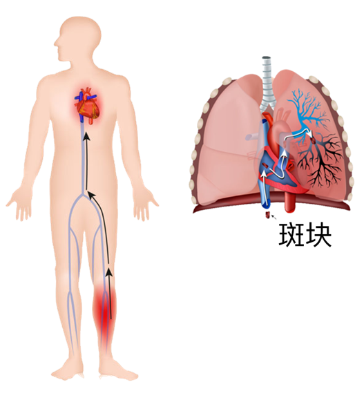 血栓是心梗、腦梗的元兇，很容易找上這些人