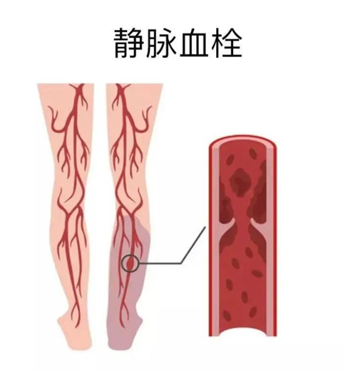 血栓是心梗、腦梗的元兇，很容易找上這些人