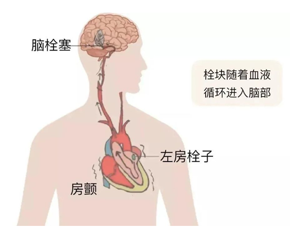 血栓是心梗、腦梗的元兇，很容易找上這些人