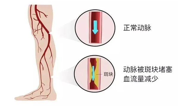 血栓是心梗、腦梗的元兇，很容易找上這些人