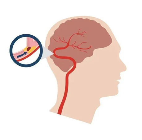 血栓是心梗、腦梗的元兇，很容易找上這些人