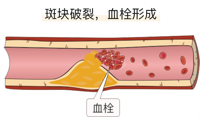 血栓是心梗、腦梗的元兇，很容易找上這些人
