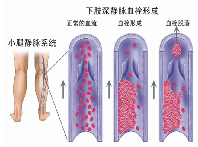 警惕！這個(gè)全球“第三大心血管殺手”，我們該如何應(yīng)對？