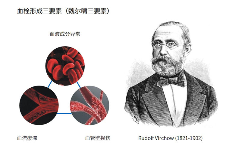 世界血栓日 | 拴不住，動(dòng)起來