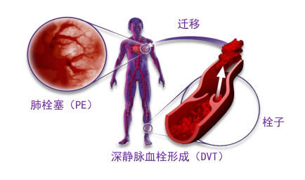 骨科術(shù)后重點(diǎn)關(guān)注的問(wèn)題—VTE，該如何防治？