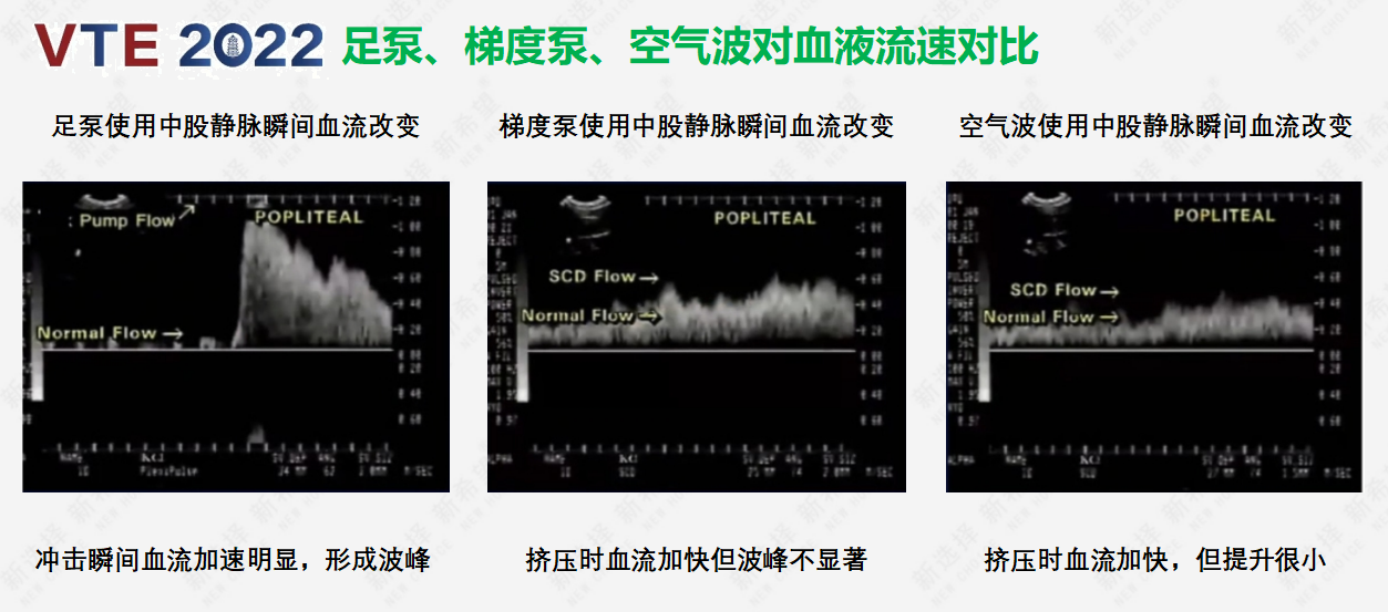 圍術(shù)期患者VTE的預(yù)防，只知道抗凝可不行