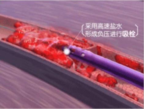 深靜脈血栓能致命，防治“大法”要了解！