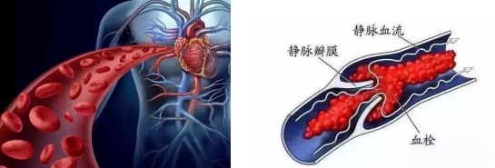 妊娠過(guò)程中的“潛伏殺手”——易栓癥