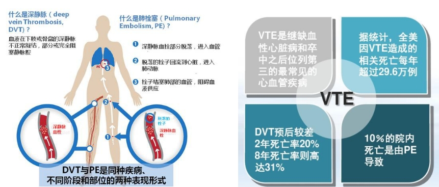 VTE的危害您了解嗎？