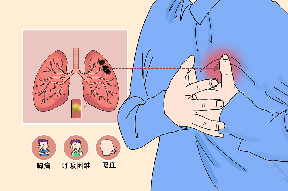 VTE的危害您了解嗎？