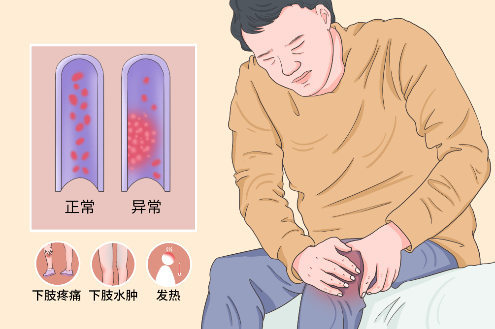 VTE的危害您了解嗎？
