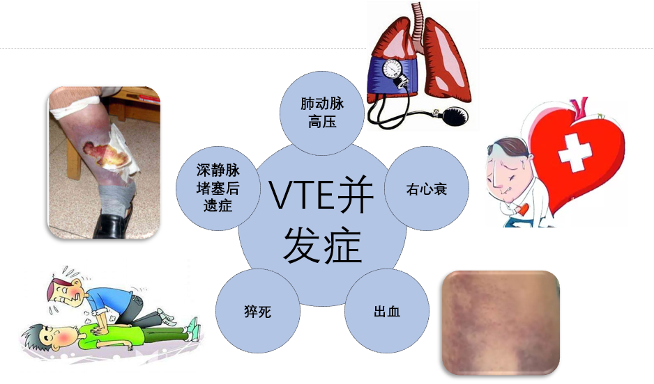 VTE的危害您了解嗎？